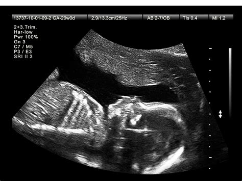 20 Week Sonogram