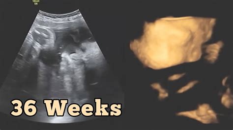36 Weeks Sonography