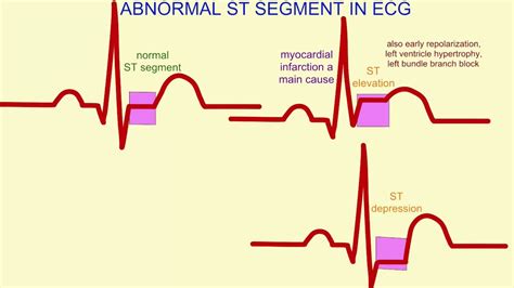 Abnormal Ecg