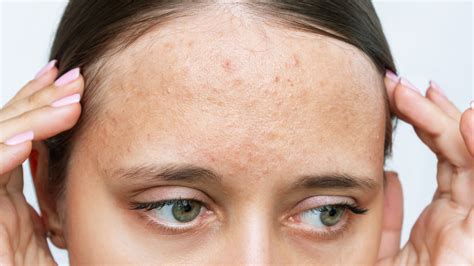 Acne On Forehead