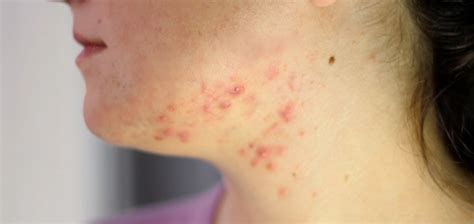 Acne On Neck