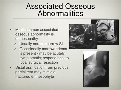 Acute Osseous Abnormality