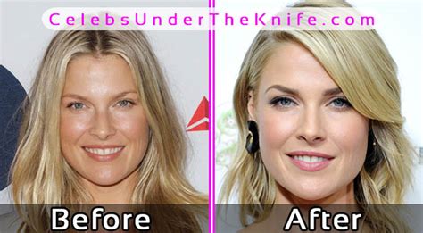 Ali Larter Face Surgery