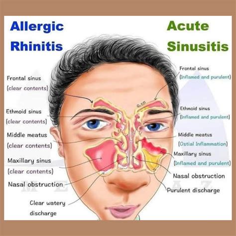 Allergies And Sinus