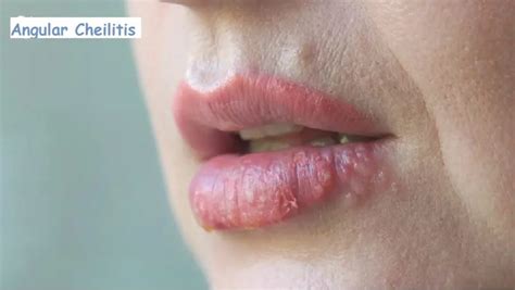 Angular Cheilitis Ointment