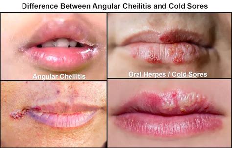 Angular Cheilitis Vs Cold Sore