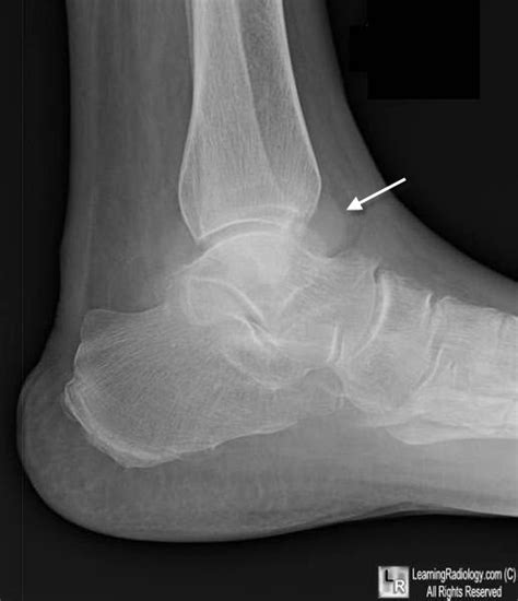 Ankle Joint Effusion