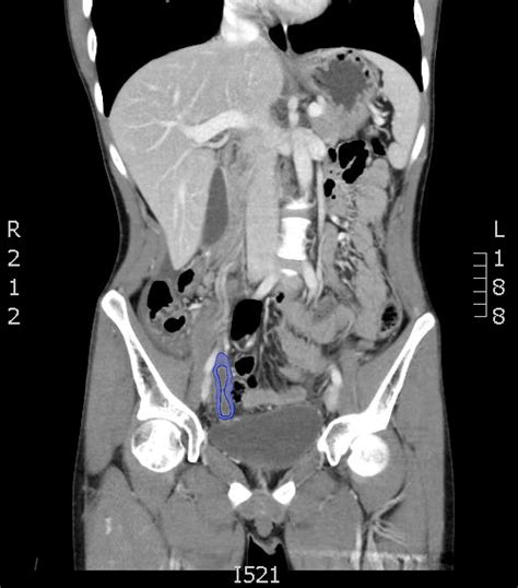 Appendicitis On Ct