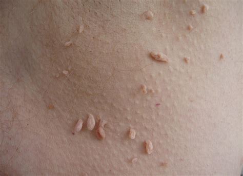Are Skin Tags Contagious
