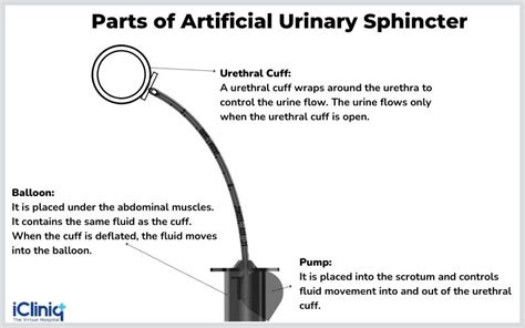 Artificial Urethral Sphincter