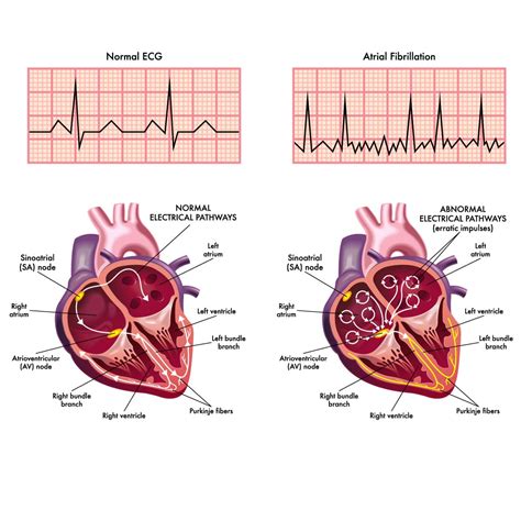 Atrial Fibrillation Lifespan