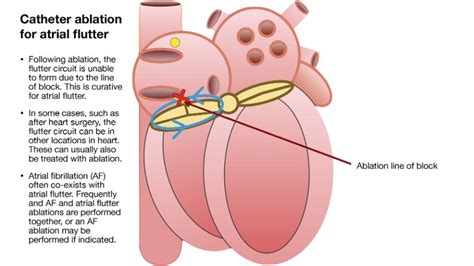Atrial Flutter Ablation