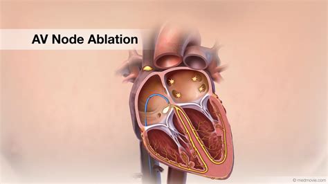Av Node Ablation