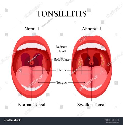 Average Size Tonsils
