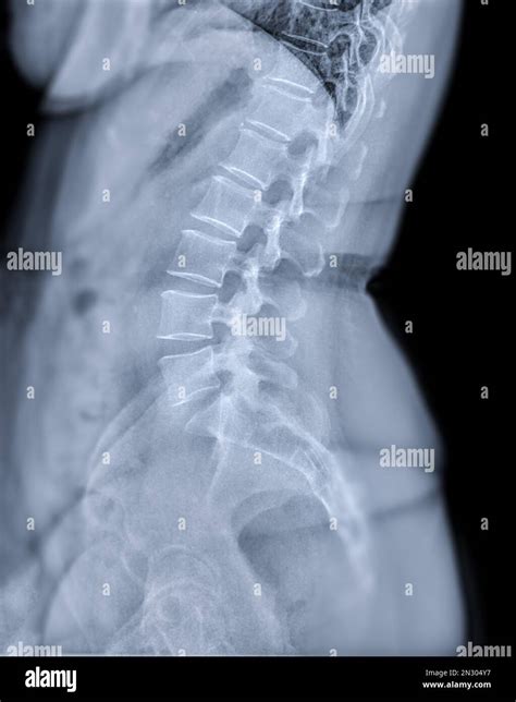 Back X Ray