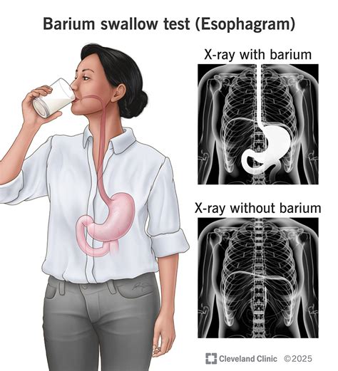 Barium Swallow Test