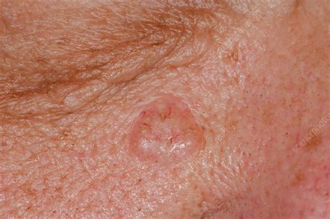Basal Cell Carcinoma Nodular Type
