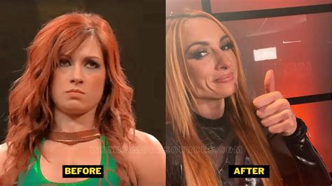 Becky Lynch Face Surgery