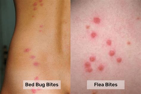 Bed Bugs One Bite