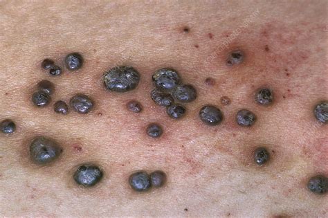 Black Spots On Scrotum