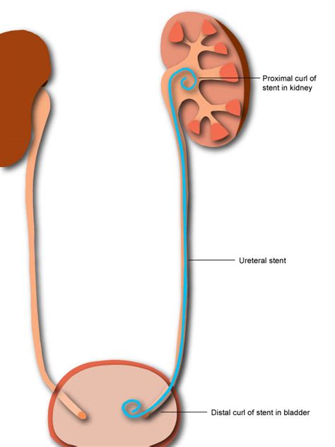 Bladder Stent Removal