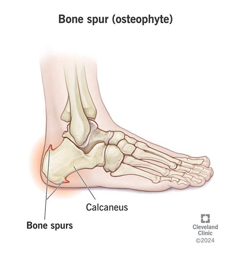 Bone Spur Foot