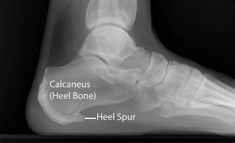 Bone Spurs In Heel