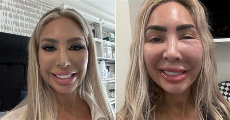Botched Face Plastic Surgery
