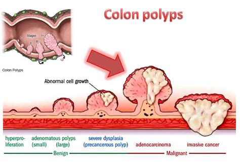 Bowel Polyps Photos