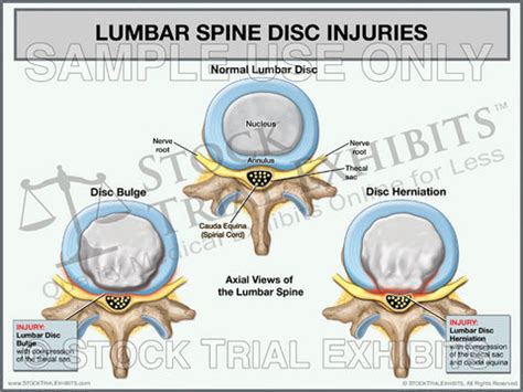 Broad Based Disc Bulge