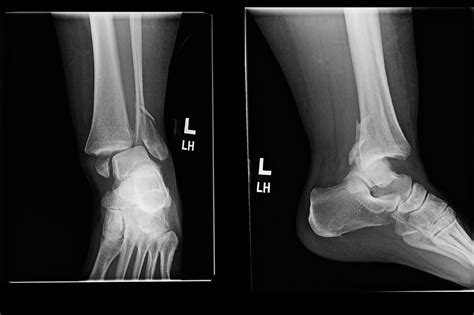 Broken Ankle Xray