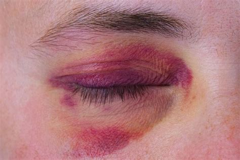 Broken Eye Socket