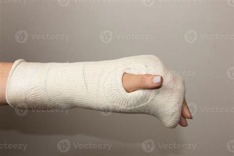 Broken Hand Cast