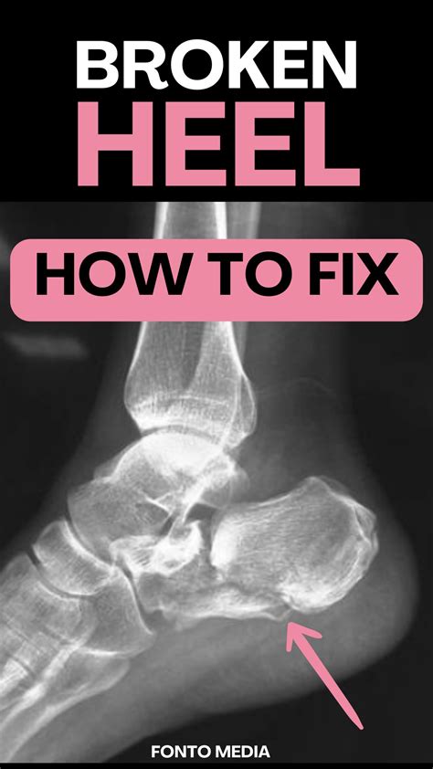 Broken Heel Bone