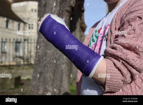 Broken Wrist Cast