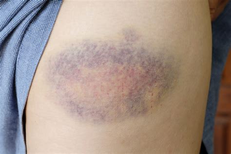 Bruise On Muscle