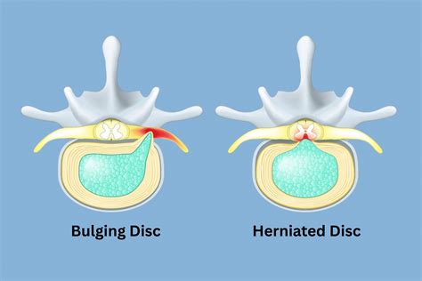 Bulging Vs Herniated Disc