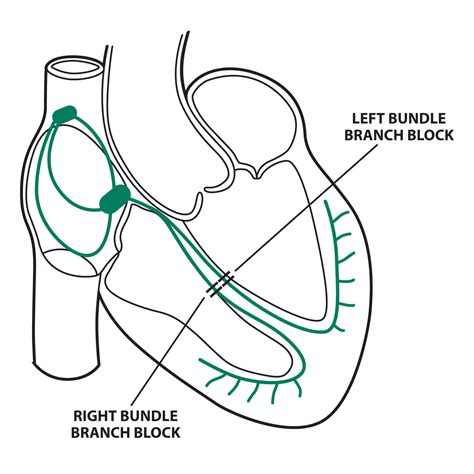Bundle Branch Blockage