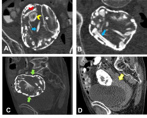 Calcification In Fetus