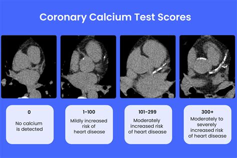 Calcium Score By Age