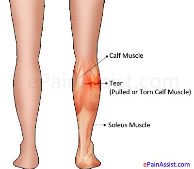 Calf Muscle Pulling