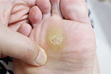 Calluses On Foot