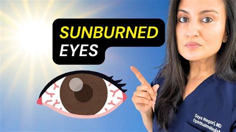 Can Your Eyes Get Sunburned
