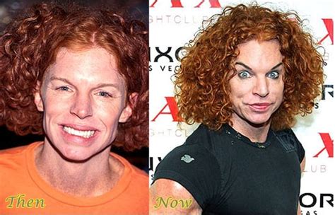 Carrot Top Face Surgery