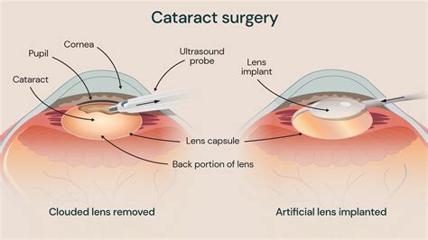 Cataract After Operation