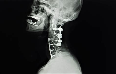 Cervical Spinal Fusion