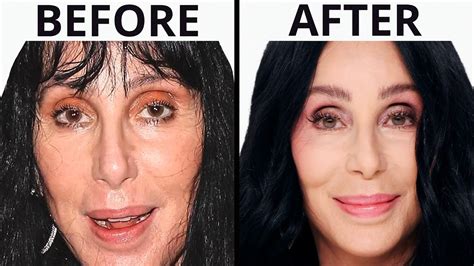 Cher Face Surgery