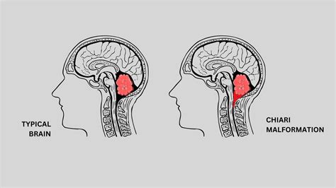 Chiari Malformation Type 2