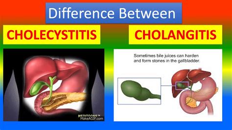Cholangitis Vs Cholecystitis