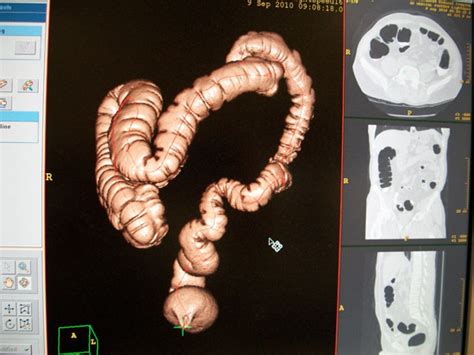 Colonoscopy Vs Virtual Colonoscopy